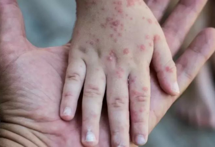 Қызылшаға қарсы қосымша жаппай иммундауда 608 мыңнан астам адам вакцинацияланды
