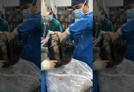 Хирургтер 30 жыл темекі шеккен адамның өкпесі қандай болатынын көрсетті (видео)