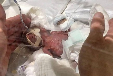 Новорожденного мальчика весом 268 граммов спасли японские врачи 