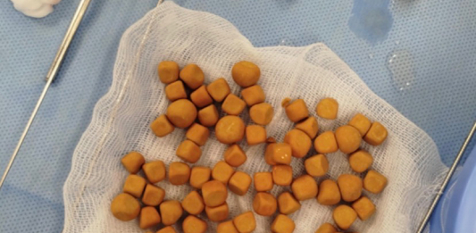 ТҮРКІСТАН: Науқастың қуығынан 80 тас алынды