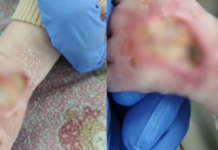 Сәбидің қолын күйдірген: Арқалық тұрғыны екі айлық баласына зақым келтірген астаналық аурухана қызметкерлерінің жазалануын талап етеді