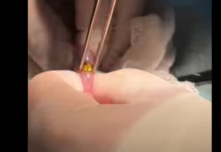 ​Шымкенттік дәрігерлер 16 магнит жұтып қойған балаға күрделі ота жасады