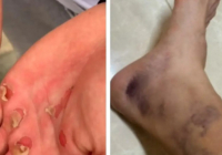 Қол-аяғы көгеріп, әбден қиналған: Дубайда жарысқа қатысқан қазақ қызы қандай қиындықтан өткенін көрсетті (ВИДЕО)