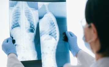 ​Өкпе эхинококкозы - жануарлардан, жуылмаған тағам немесе су арқылы жұғады