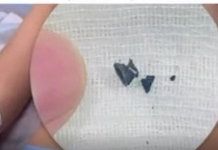 Алматыда дәрігерлер 5 жасар баланың өкпесінен тирдың оғын алып шықты 