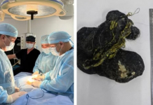 Шымкенттік дәрігерлер 8 жастағы баланың асқазанынан ірі көлемді шаш алды