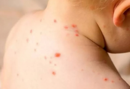 Жетісу облысында қызылшамен ауырғандар саны күрт өсті