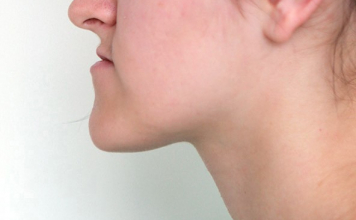 Иектің алға шығуы сақаулыққа апарады