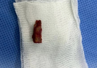 Дәрігерлер баланың басынан 5 жыл бұрын қадалған бұтақты алып шықты