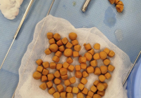 ТҮРКІСТАН: Науқастың қуығынан 80 тас алынды