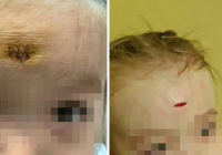 Алматыда балабақша тәрбиешісі баланың маңдайын жарып жіберген
