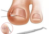 Тырнақ «ішке өсіп», етті ауыртса не істеу керек