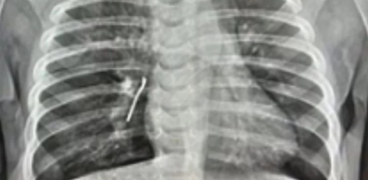 Ақтауда 11 айлық баланың өкпесінен шемішкенің қабығы табылды