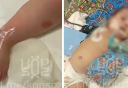 Астанада 9 айлық сәби ауруханада емделу кезінде күйіп қалған