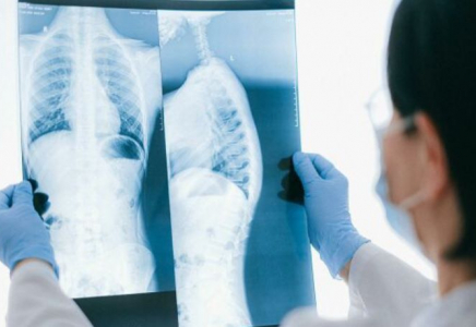 ​Өкпе эхинококкозы - жануарлардан, жуылмаған тағам немесе су арқылы жұғады