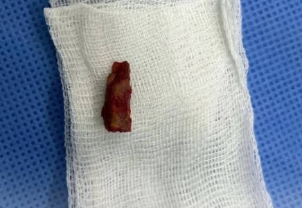 Дәрігерлер баланың басынан 5 жыл бұрын қадалған бұтақты алып шықты