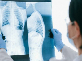 ​Өкпе эхинококкозы - жануарлардан, жуылмаған тағам немесе су арқылы жұғады