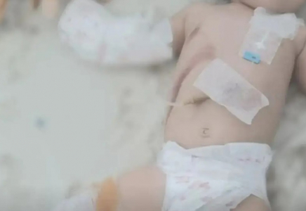 «Денесінің 30 пайызы күйіп қалған»: полиция 3 ай бұрын болған оқиғаға байланысты жауап берді