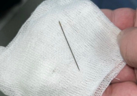 ТҮРКІСТАН: 8 айлық сәбидің іш қуысынан ине табылды