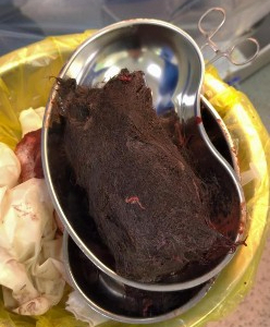 ТҮРКІСТАН: 15 жастағы қыздың ішінен 1 келі шаш шықты