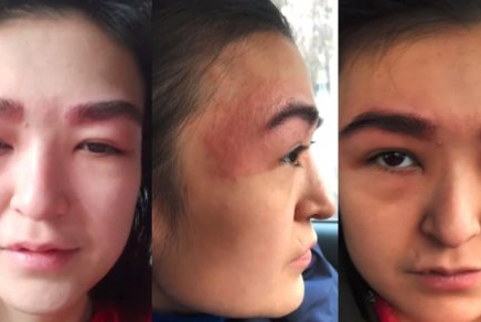 Сұлулық салонына барған қыздың бетіне бөртпе шыққан