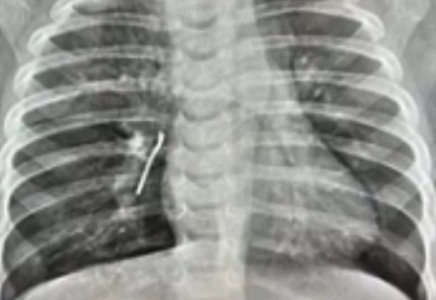 Ақтауда 11 айлық баланың өкпесінен шемішкенің қабығы табылды